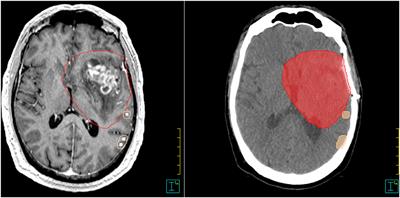 Automatic Radiotherapy Planning for Glioblastoma Radiotherapy With Sparing of the Hippocampus and nTMS-Defined Motor Cortex